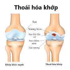 Degenerative Joint Disease - Hình ảnh minh họa